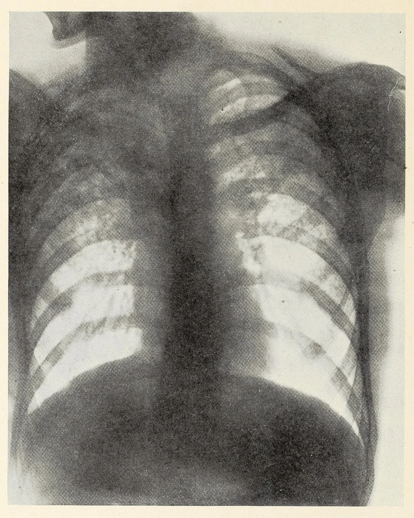 An illustration from The Journal of roentgenology, 1918, leaf 238