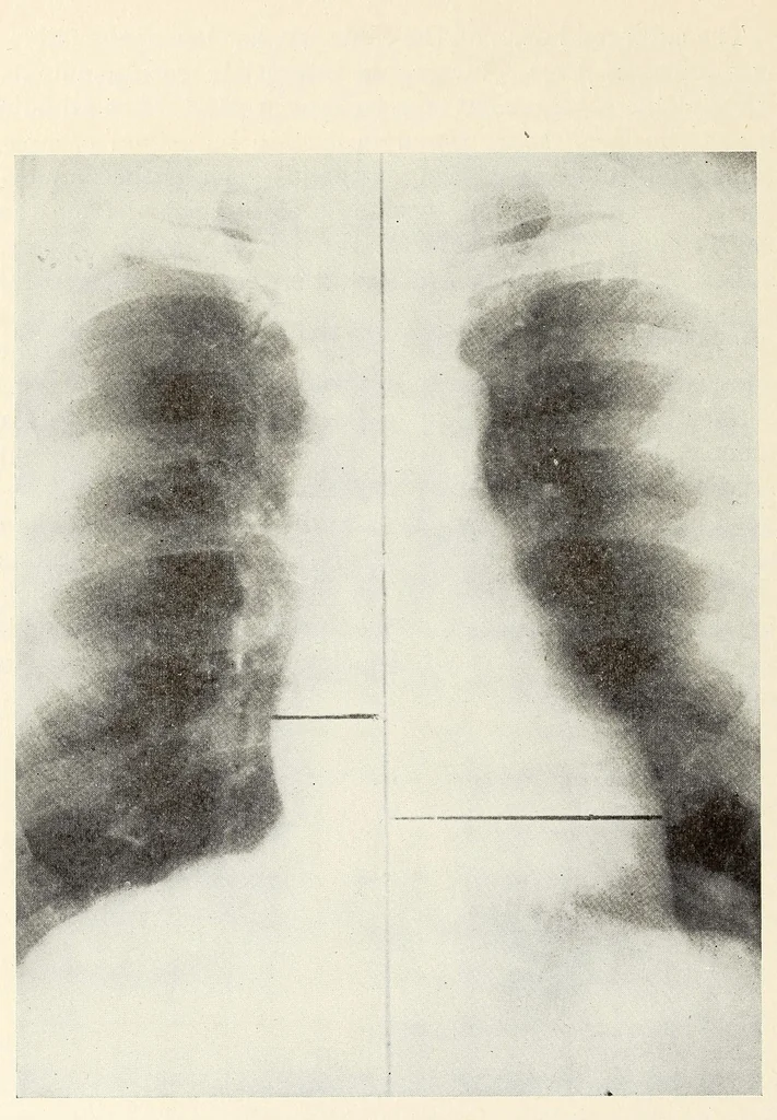 An illustration from The Journal of roentgenology, 1918, leaf 346