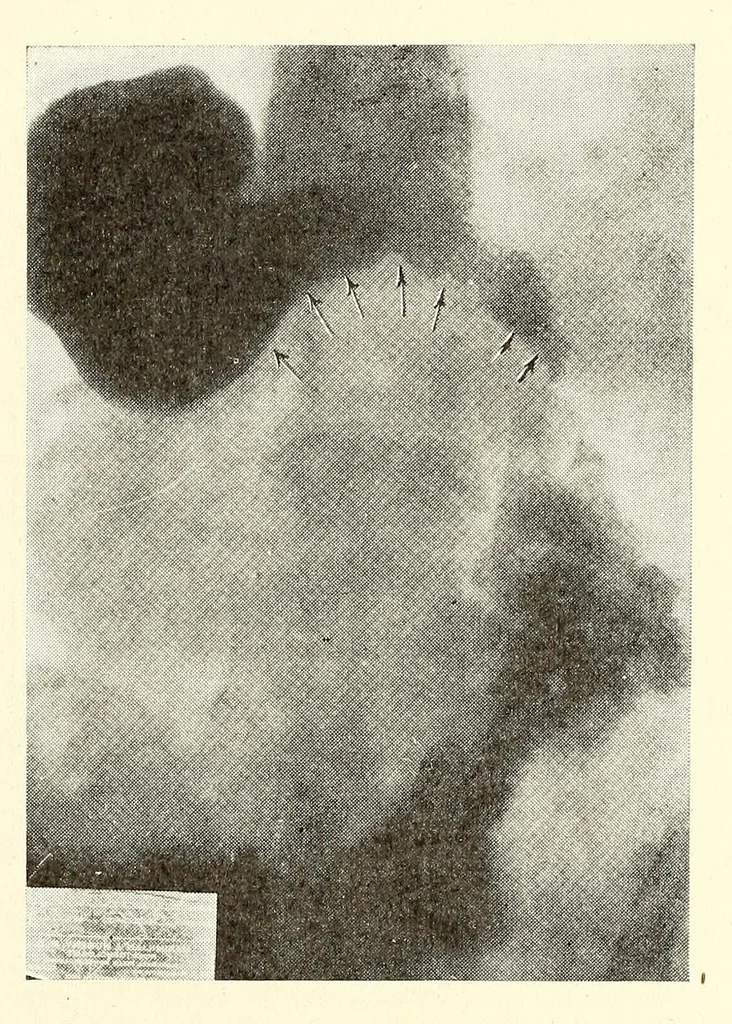 An illustration from The Journal of roentgenology, 1918, leaf 367