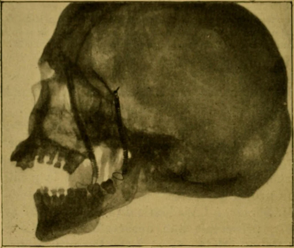 An illustration from La photographie de l'invisible : les rayons X suivi d'un glossaire, 1898, leaf 143