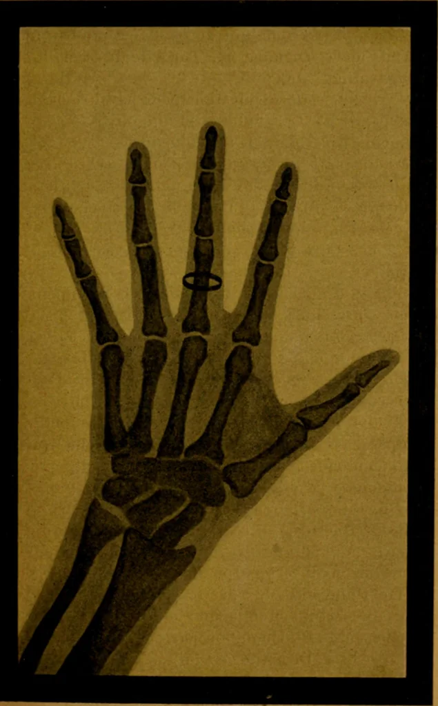 An illustration from La photographie de l'invisible : les rayons X suivi d'un glossaire, 1898, leaf 76