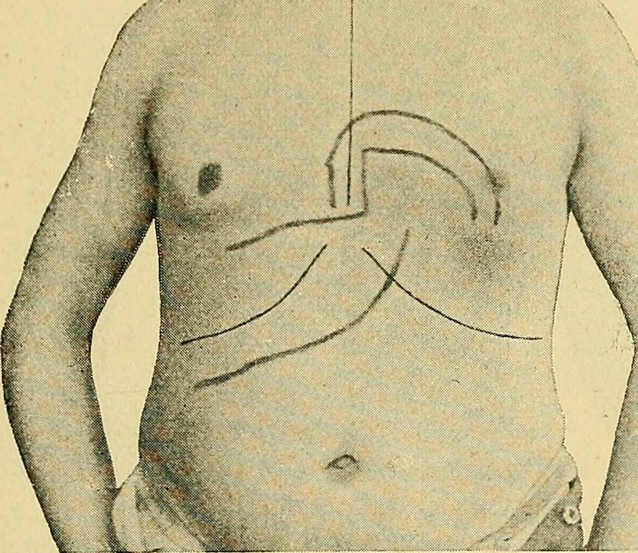 An illustration from Lehrbuch der Krankheiten des Herzens und der Blutgefässe, 1906, leaf 114