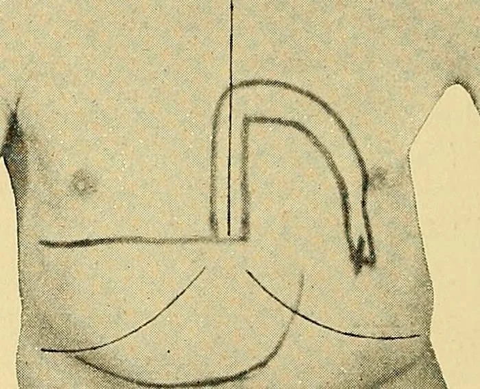 An illustration from Lehrbuch der Krankheiten des Herzens und der Blutgefässe, 1906, leaf 171