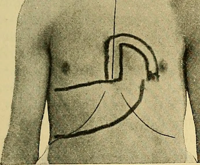 An illustration from Lehrbuch der Krankheiten des Herzens und der Blutgefässe, 1906, leaf 198