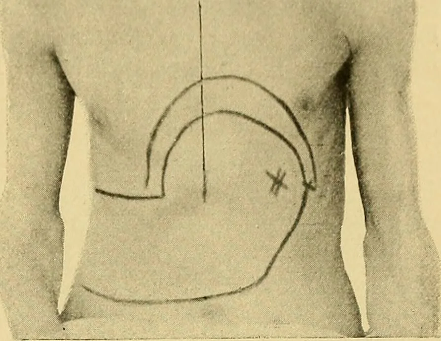 An illustration from Lehrbuch der Krankheiten des Herzens und der Blutgefässe, 1906, leaf 210