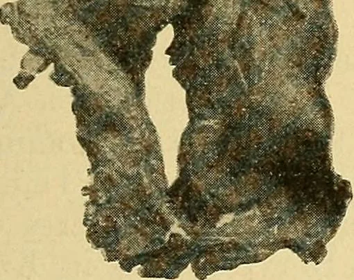 An illustration from Lehrbuch der Krankheiten des Herzens und der Blutgefässe, 1906, leaf 210