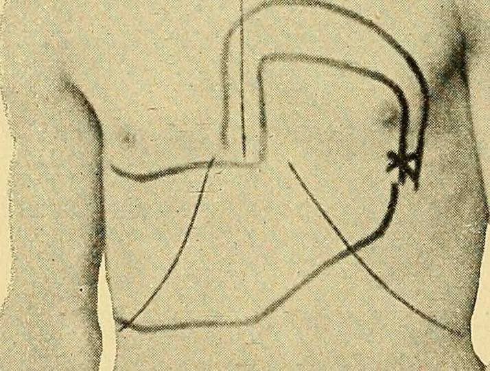 An illustration from Lehrbuch der Krankheiten des Herzens und der Blutgefässe, 1906, leaf 211