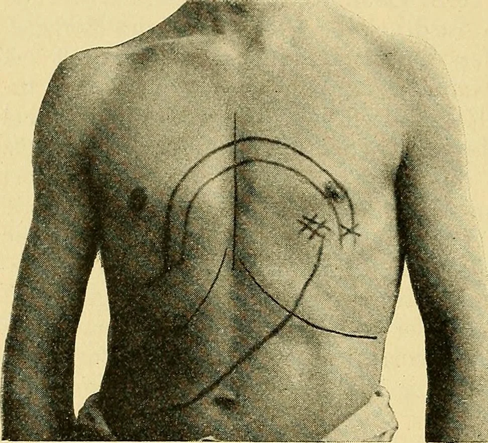 An illustration from Lehrbuch der Krankheiten des Herzens und der Blutgefässe, 1906, leaf 221