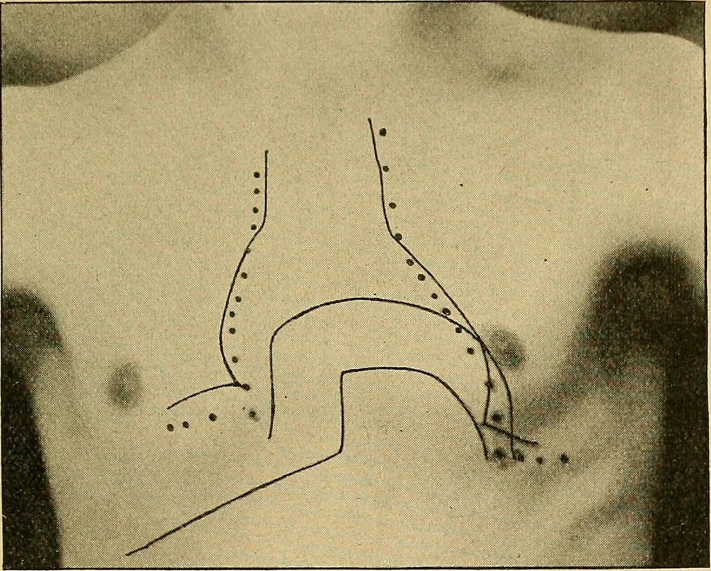 An illustration from Lehrbuch der Krankheiten des Herzens und der Blutgefässe, 1906, leaf 34