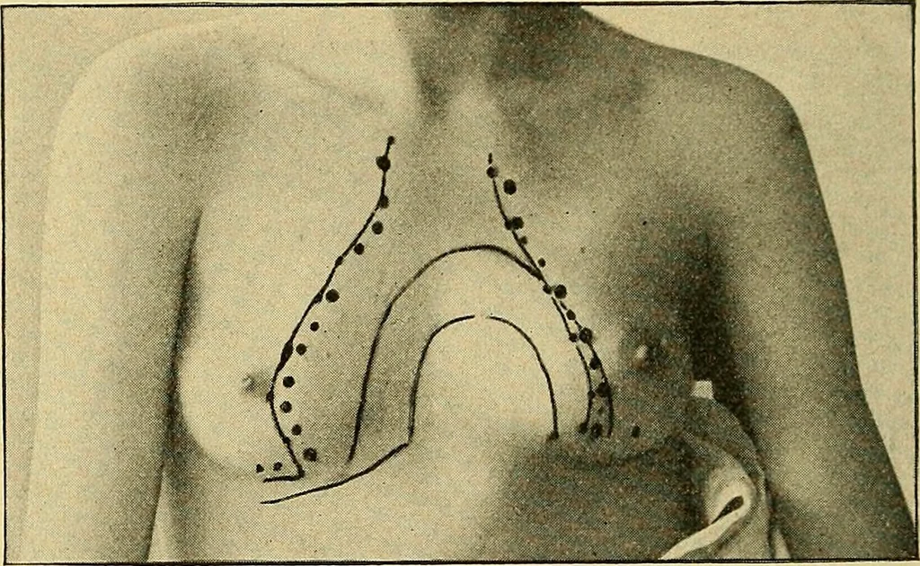 An illustration from Lehrbuch der Krankheiten des Herzens und der Blutgefässe, 1906, leaf 35