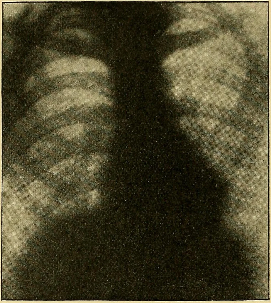 An illustration from Lehrbuch der Krankheiten des Herzens und der Blutgefässe, 1906, leaf 37