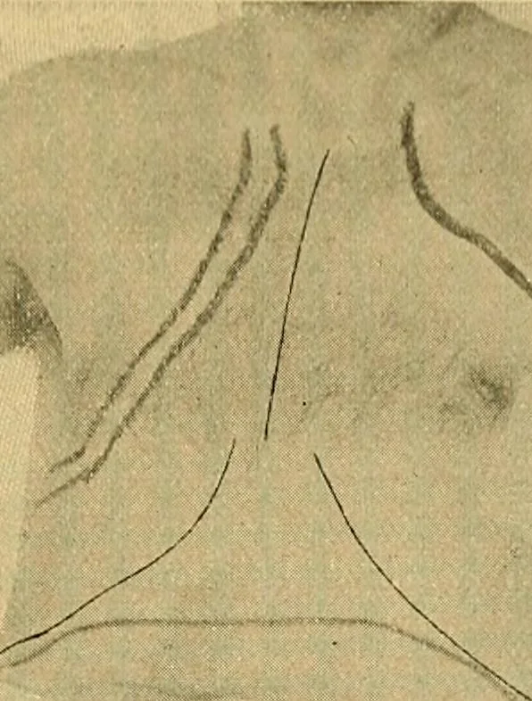 An illustration from Lehrbuch der Krankheiten des Herzens und der Blutgefässe, 1906, leaf 390