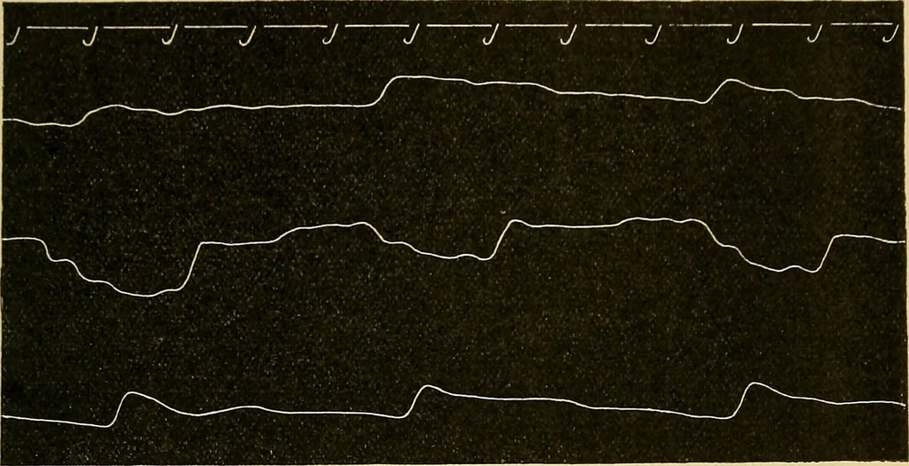 An illustration from Lehrbuch der Krankheiten des Herzens und der Blutgefässe, 1906, leaf 406