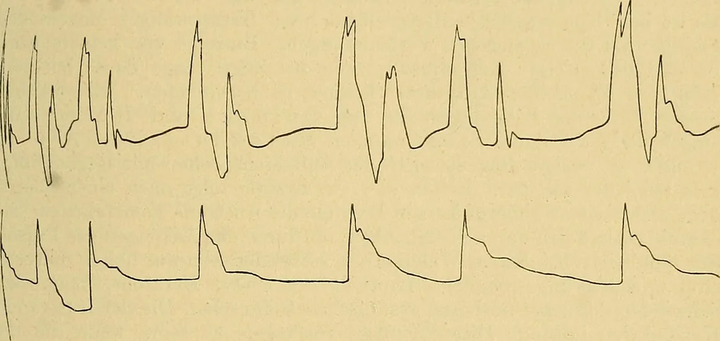 An illustration from Lehrbuch der Krankheiten des Herzens und der Blutgefässe, 1906, leaf 64