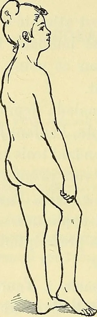 An illustration from Leçons cliniques de chirurgie infantile : deuxième série, 1905, leaf 141