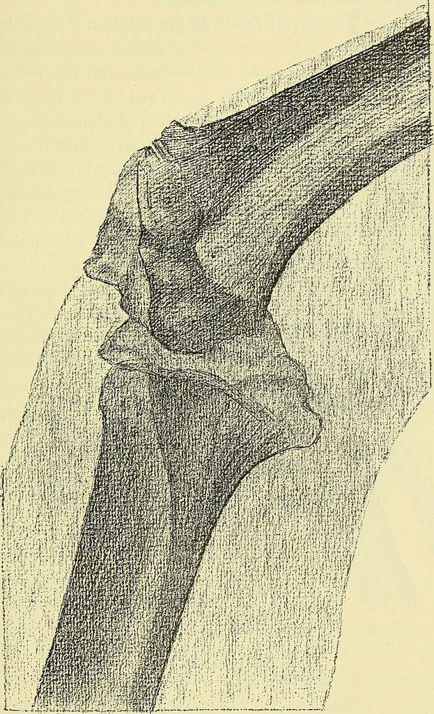 An illustration from Leçons cliniques de chirurgie infantile : deuxième série, 1905, leaf 220