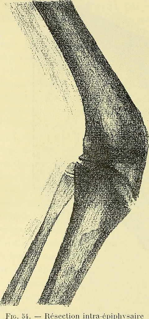 An illustration from Leçons cliniques de chirurgie infantile : deuxième série, 1905, leaf 221