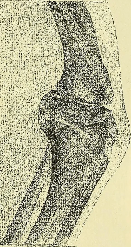 An illustration from Leçons cliniques de chirurgie infantile : deuxième série, 1905, leaf 222