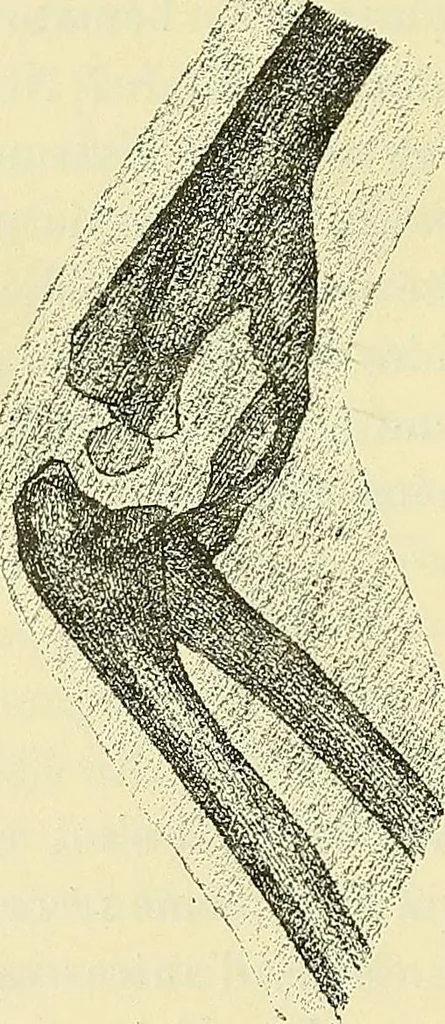 An illustration from Leçons cliniques de chirurgie infantile : deuxième série, 1905, leaf 247
