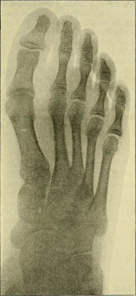 An illustration from Leçons cliniques de chirurgie infantile : deuxième série, 1905, leaf 310