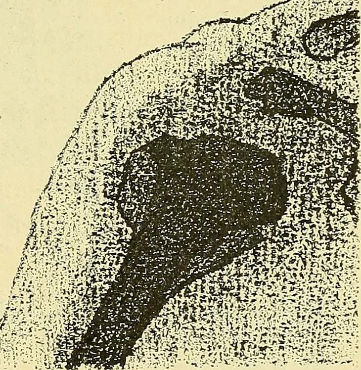 An illustration from Leçons cliniques de chirurgie infantile : deuxième série, 1905, leaf 32