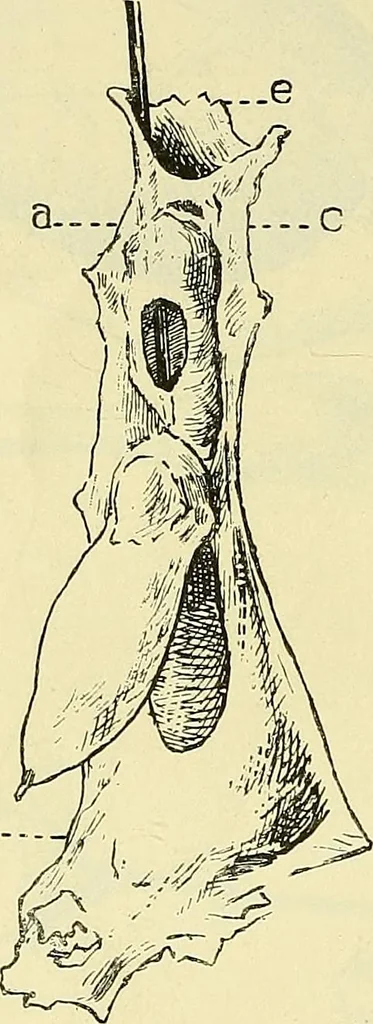 An illustration from Leçons cliniques de chirurgie infantile : deuxième série, 1905, leaf 393