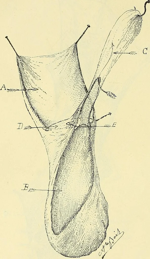 An illustration from Leçons cliniques de chirurgie infantile : deuxième série, 1905, leaf 395