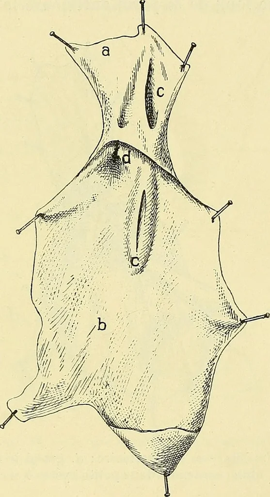 An illustration from Leçons cliniques de chirurgie infantile : deuxième série, 1905, leaf 396