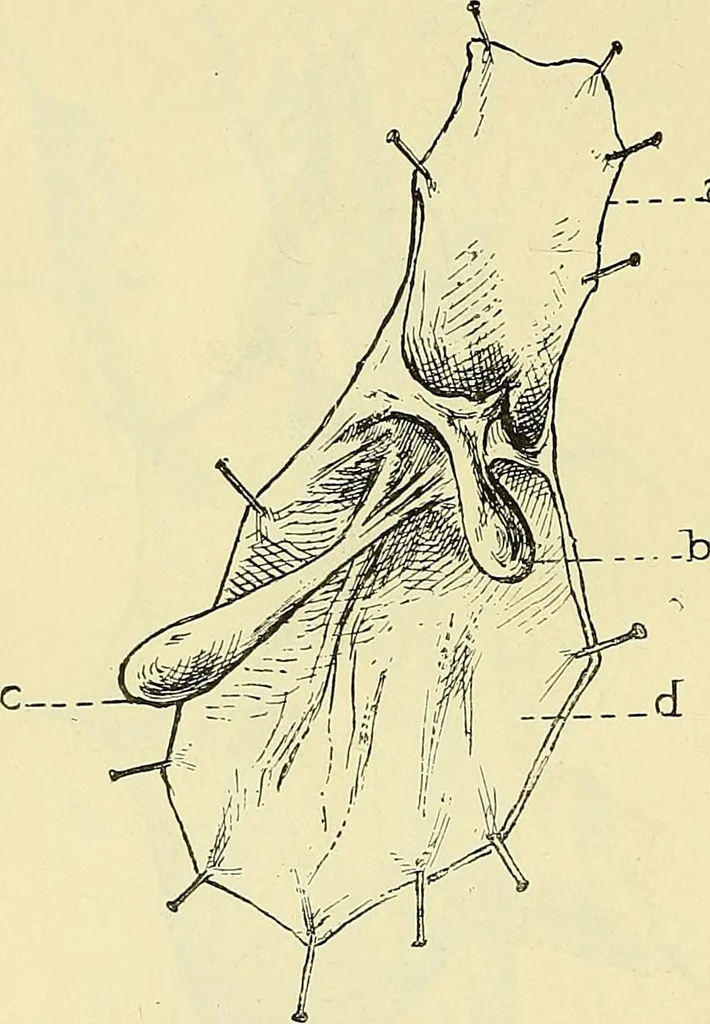 An illustration from Leçons cliniques de chirurgie infantile : deuxième série, 1905, leaf 397