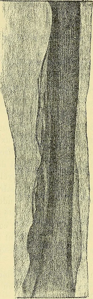 An illustration from Leçons cliniques de chirurgie infantile : deuxième série, 1905, leaf 41
