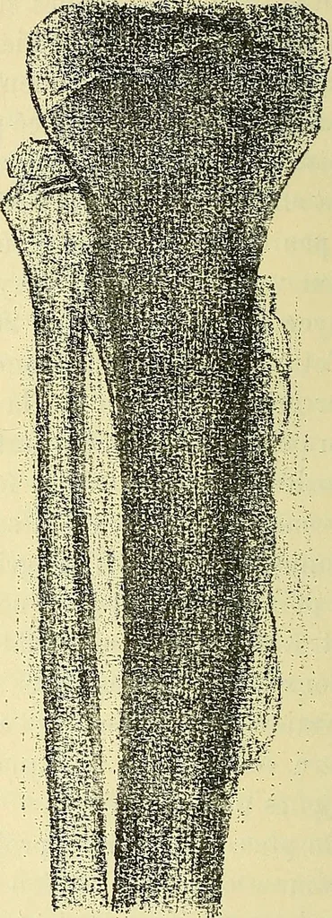 An illustration from Leçons cliniques de chirurgie infantile : deuxième série, 1905, leaf 41