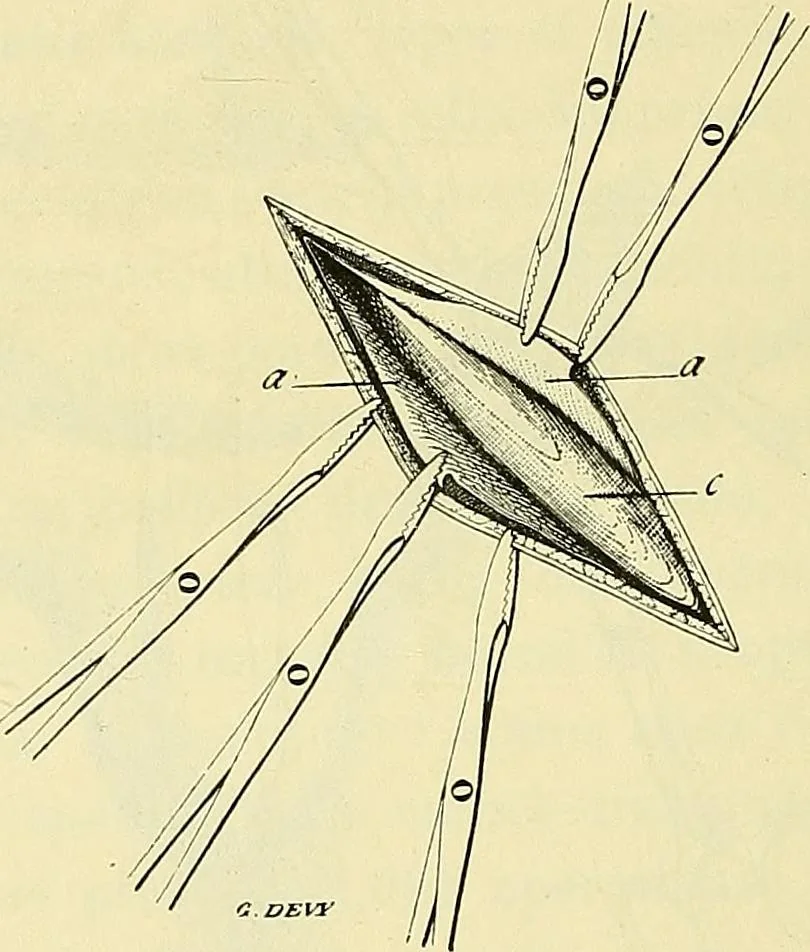 An illustration from Leçons cliniques de chirurgie infantile : deuxième série, 1905, leaf 449