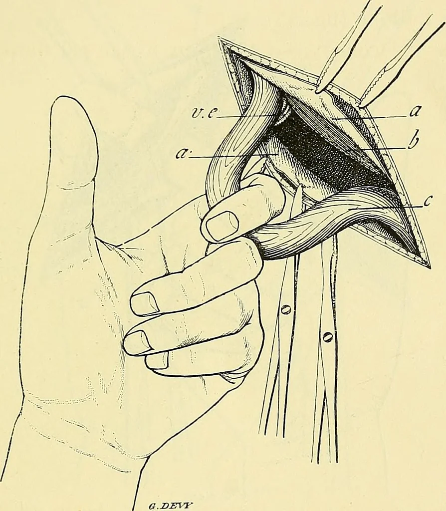 An illustration from Leçons cliniques de chirurgie infantile : deuxième série, 1905, leaf 450
