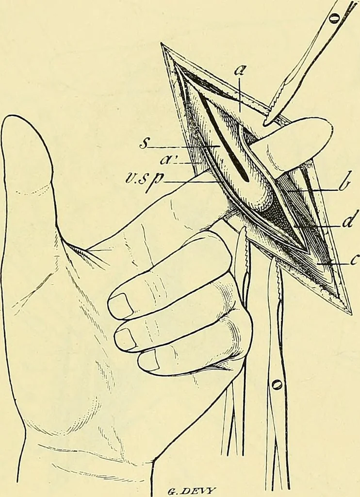 An illustration from Leçons cliniques de chirurgie infantile : deuxième série, 1905, leaf 452