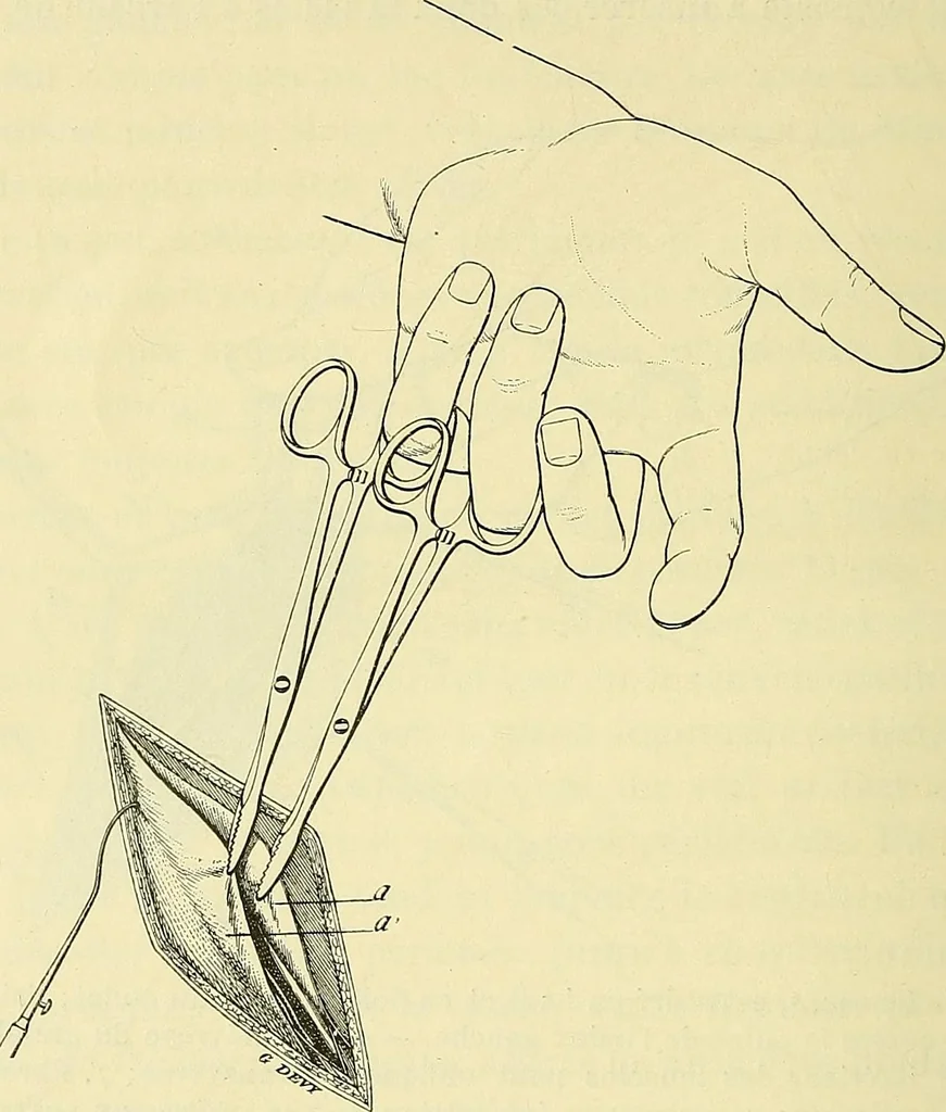 An illustration from Leçons cliniques de chirurgie infantile : deuxième série, 1905, leaf 457
