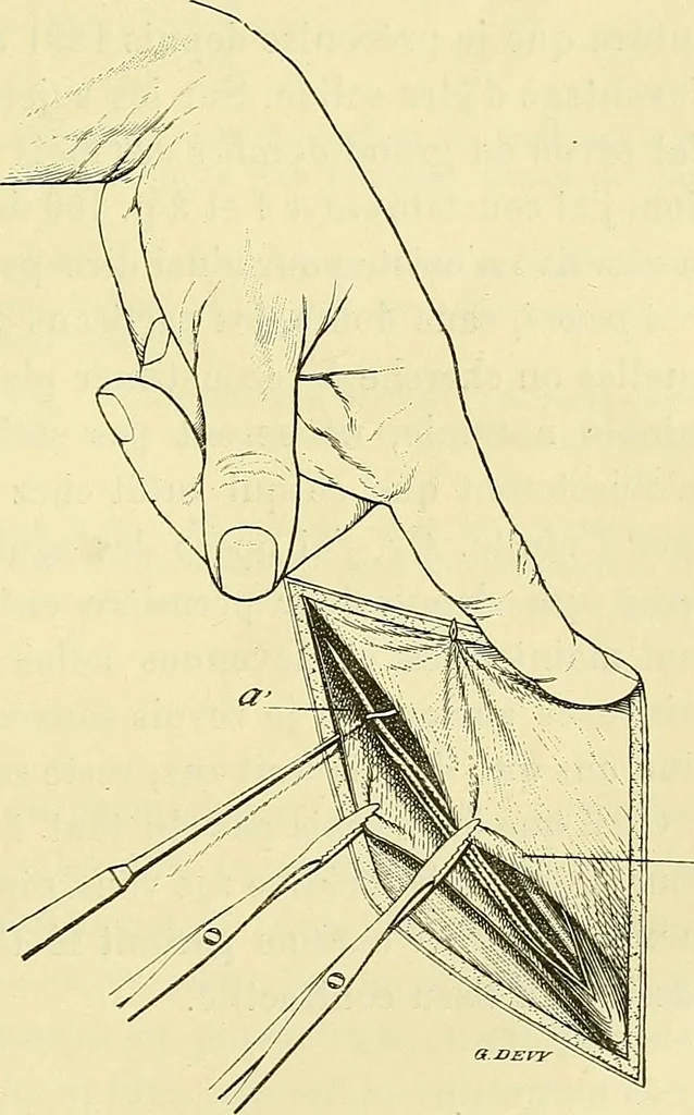 An illustration from Leçons cliniques de chirurgie infantile : deuxième série, 1905, leaf 458