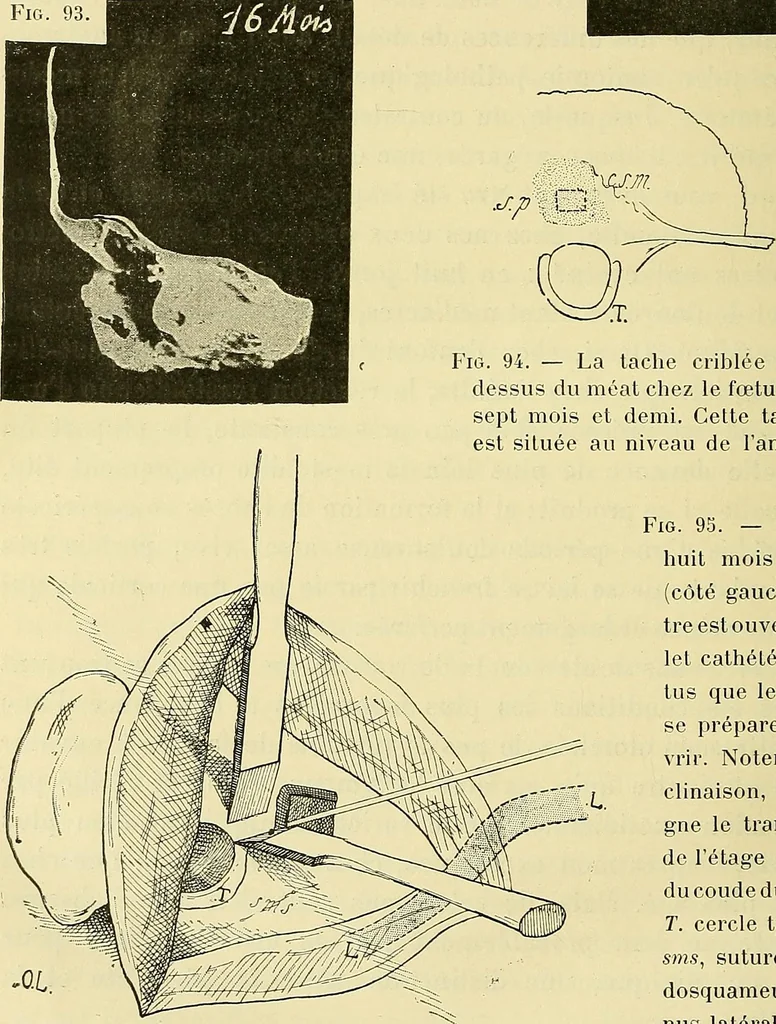 An illustration from Leçons cliniques de chirurgie infantile : deuxième série, 1905, leaf 565