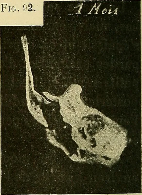 An illustration from Leçons cliniques de chirurgie infantile : deuxième série, 1905, leaf 565