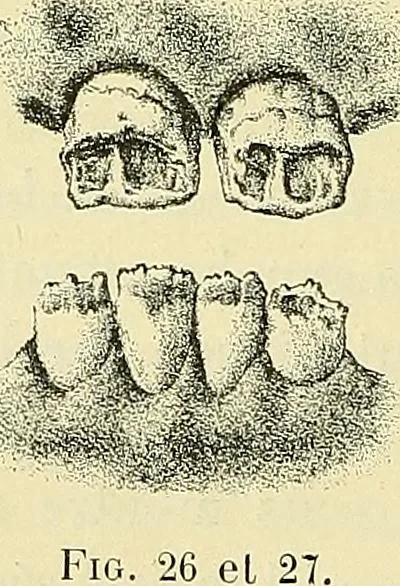 An illustration from Leçons cliniques de chirurgie infantile : deuxième série, 1905, leaf 59