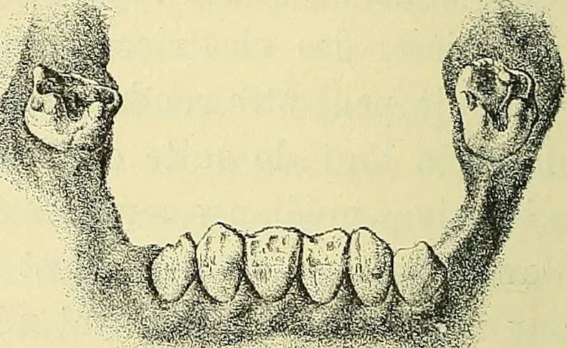 An illustration from Leçons cliniques de chirurgie infantile : deuxième série, 1905, leaf 59