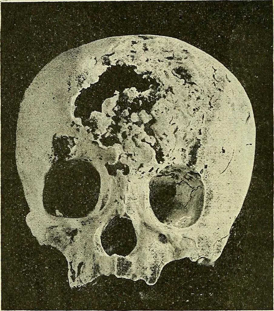 An illustration from Leçons cliniques de chirurgie infantile : deuxième série, 1905, leaf 69