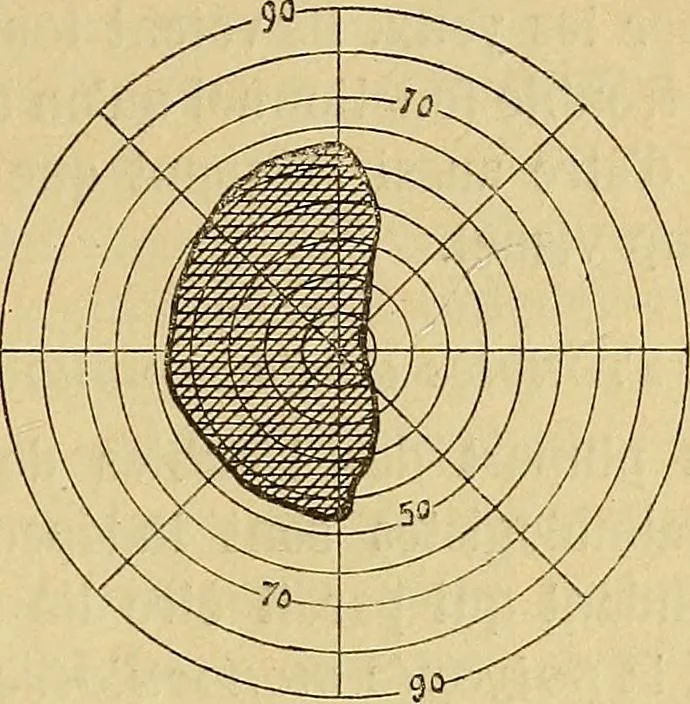 An illustration from Leçons cliniques sur l'hystérie et l'hypnotisme : faites à l'Hôpital Saint-André de Bordeaux, 1891, leaf 116