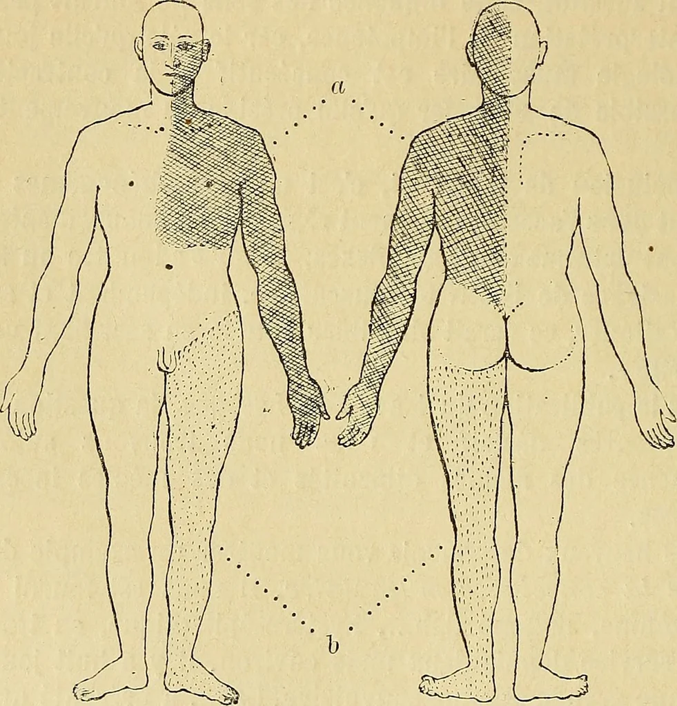 An illustration from Leçons cliniques sur l'hystérie et l'hypnotisme : faites à l'Hôpital Saint-André de Bordeaux, 1891, leaf 133