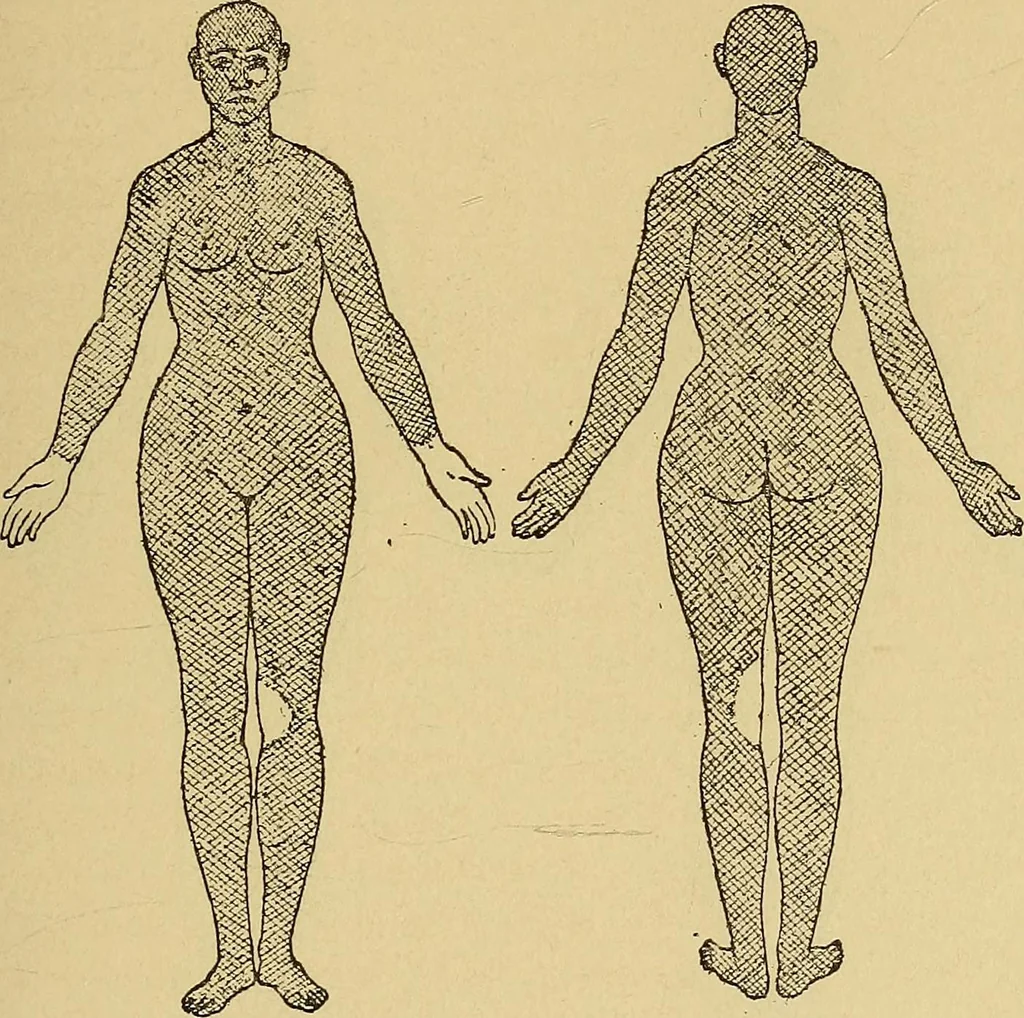An illustration from Leçons cliniques sur l'hystérie et l'hypnotisme : faites à l'Hôpital Saint-André de Bordeaux, 1891, leaf 146