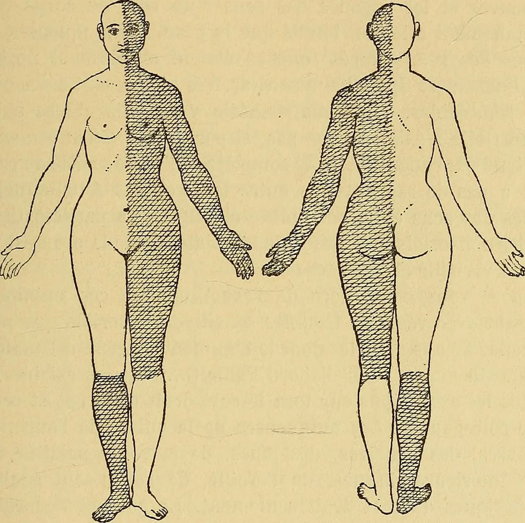 An illustration from Leçons cliniques sur l'hystérie et l'hypnotisme : faites à l'Hôpital Saint-André de Bordeaux, 1891, leaf 150