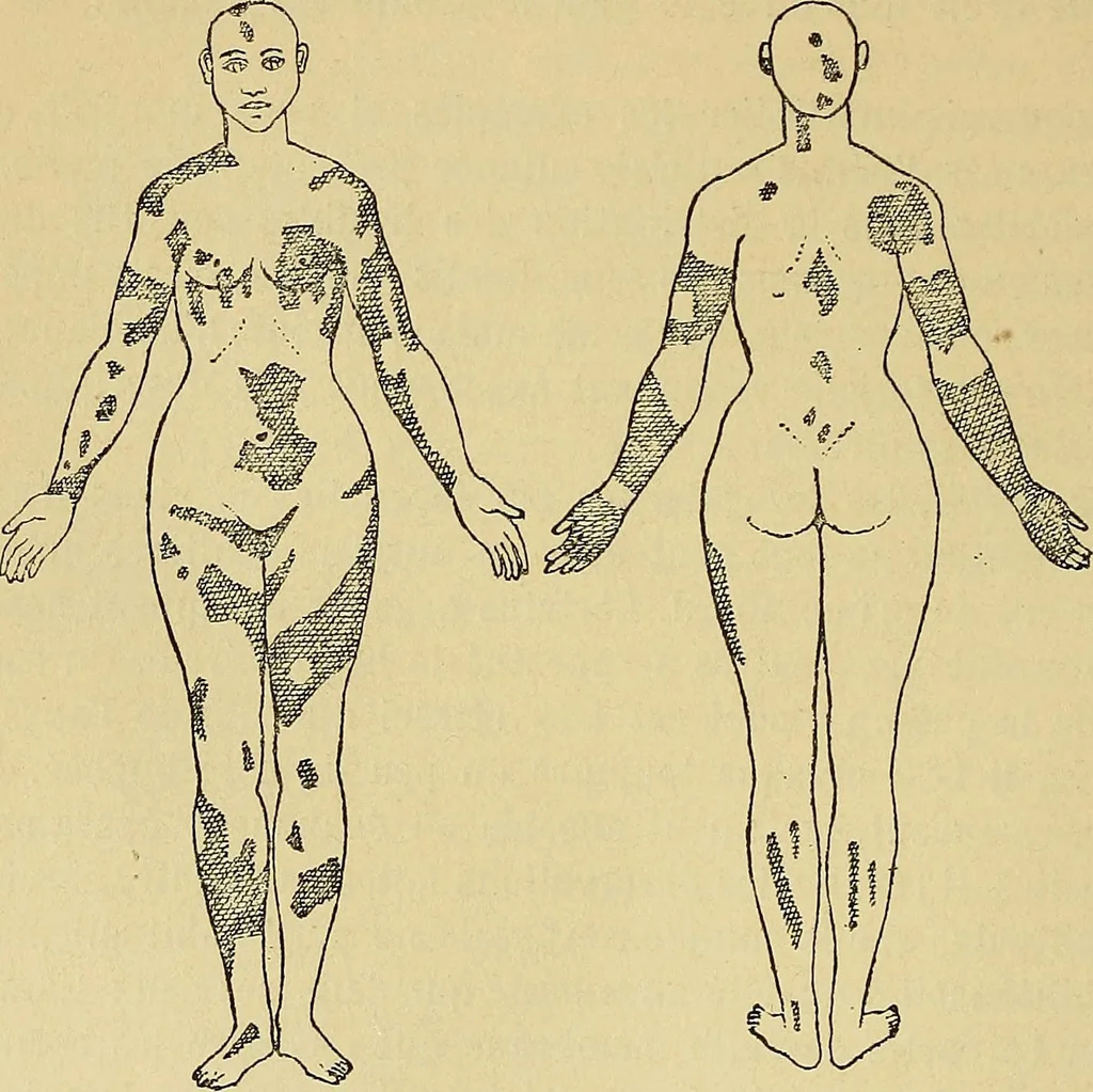 An illustration from Leçons cliniques sur l'hystérie et l'hypnotisme : faites à l'Hôpital Saint-André de Bordeaux, 1891, leaf 153