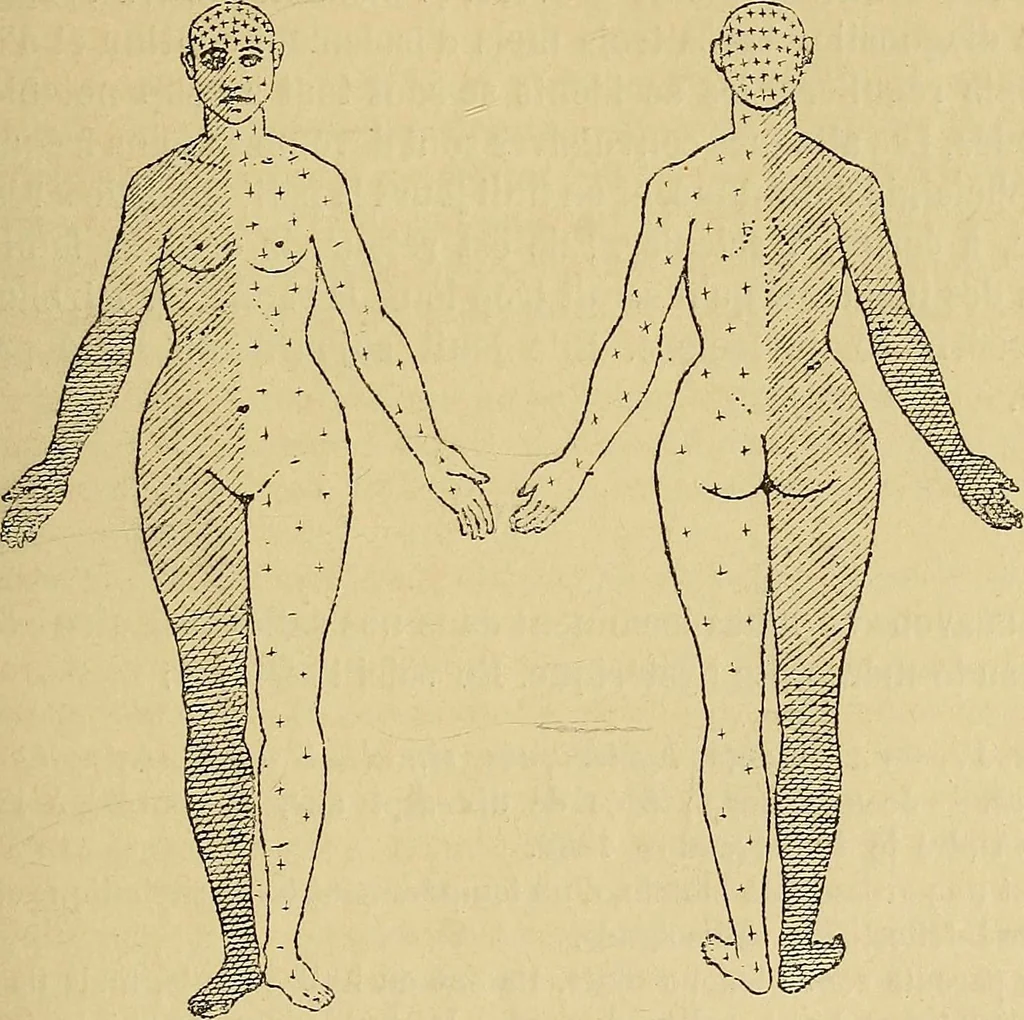 An illustration from Leçons cliniques sur l'hystérie et l'hypnotisme : faites à l'Hôpital Saint-André de Bordeaux, 1891, leaf 218