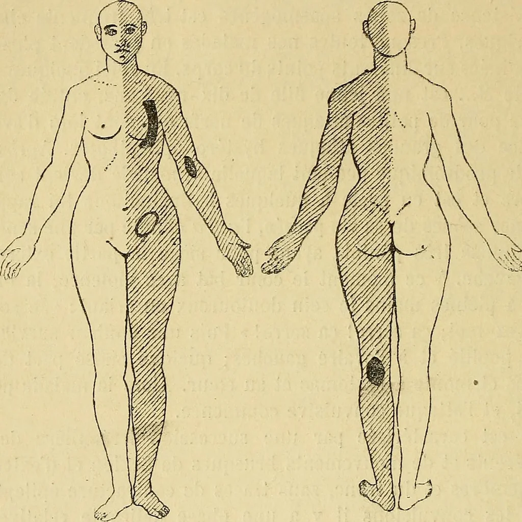 An illustration from Leçons cliniques sur l'hystérie et l'hypnotisme : faites à l'Hôpital Saint-André de Bordeaux, 1891, leaf 255