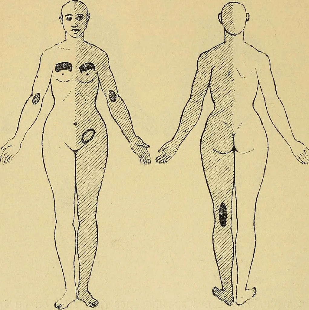 An illustration from Leçons cliniques sur l'hystérie et l'hypnotisme : faites à l'Hôpital Saint-André de Bordeaux, 1891, leaf 257