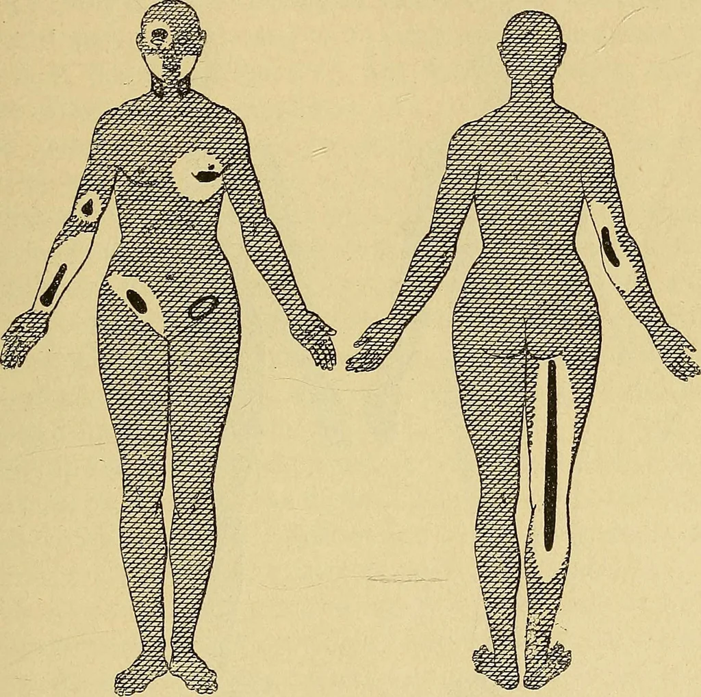 An illustration from Leçons cliniques sur l'hystérie et l'hypnotisme : faites à l'Hôpital Saint-André de Bordeaux, 1891, leaf 260